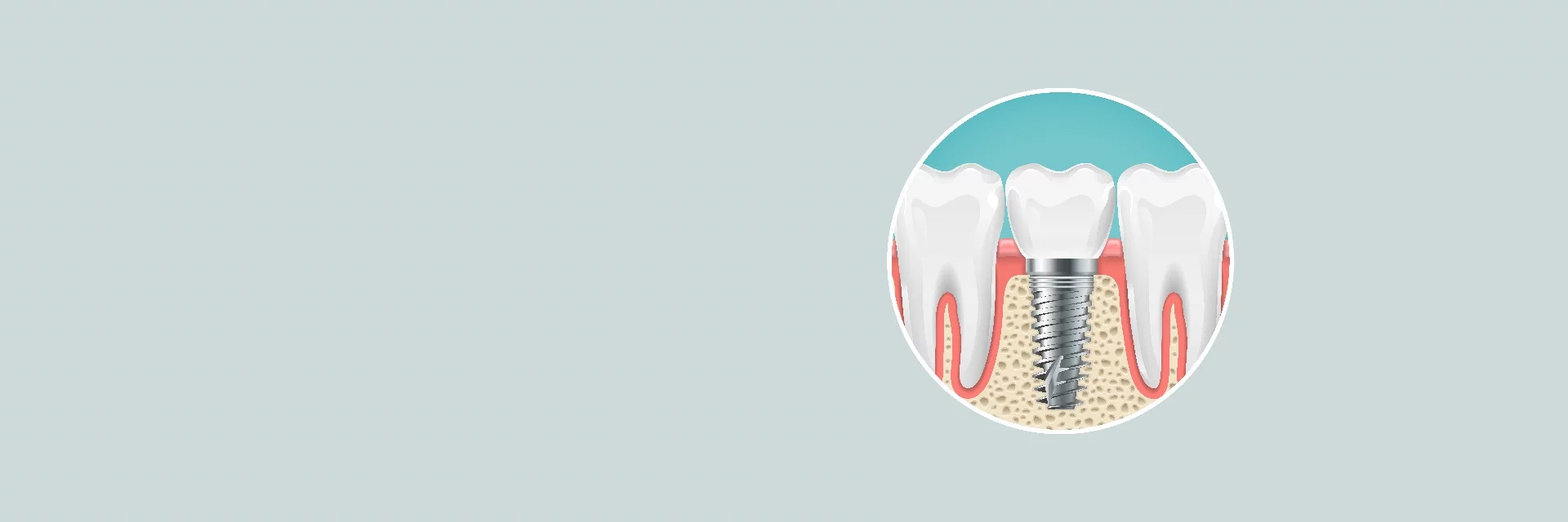 Implants dentaires